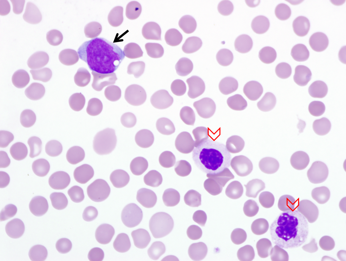 Image 1. Peripheral blood smear demonstrating circulating blasts (arrow) and dysgranulopoiesis including hypogranulation, hypolobation, and pseudo-Pelger-Huet forms (arrow heads).